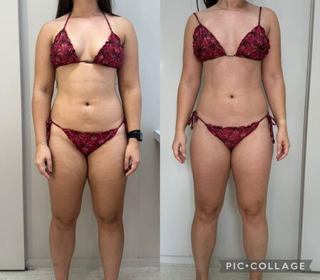 Resultado drenagem vibratória frente - Dra. Anna Abreu